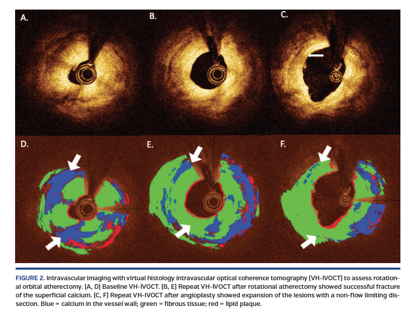 Virtual Histology Optical Coherence Tomography Imagin vrogue.co